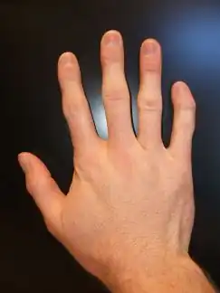 Clinodactyly – abnormal curvature of 5th finger towards 4th finger
