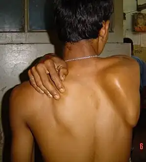 Winging of the right scapula