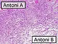 Micrograph of a schwannoma showing both a cellular Antoni A area (top) and a loose paucicellular Antoni B area (bottom). HE stain.