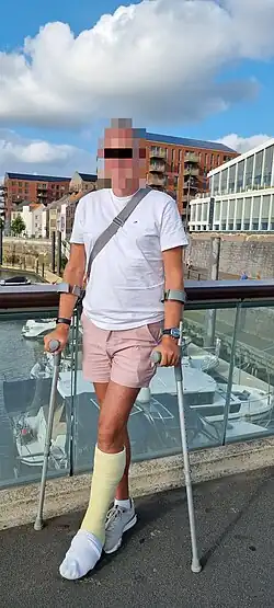 Man on crutches wearing a week old white synthetic short leg cast with sock over the toes