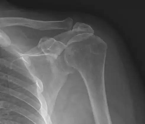 Shoulder impingement syndrome. Frontal X-ray of left shoulder.