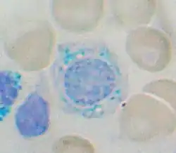 A ring sideroblast visualized by Prussian blue stain