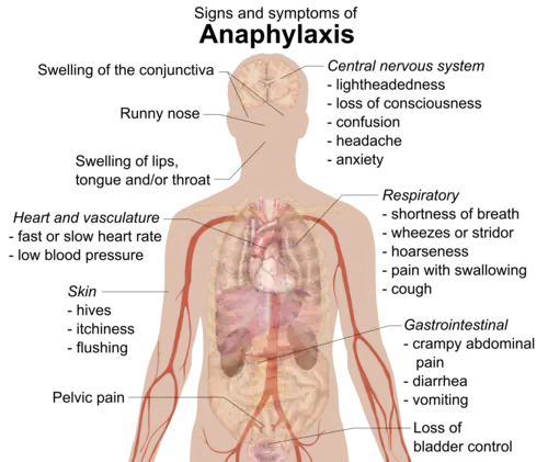 Signs and symptoms of anaphylaxis