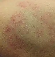 Multiple spider angiomas