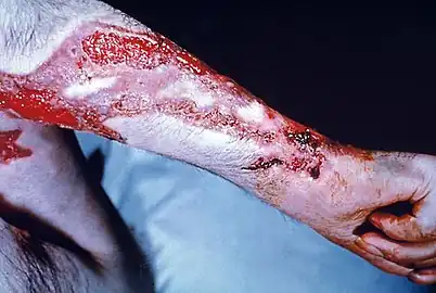 Sporotrichosis by the fungus Sporothrix schenckii