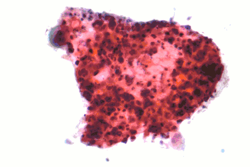 Micrograph of a squamous carcinoma, a type of nonsmall-cell lung carcinoma, FNA specimen, Pap stain.