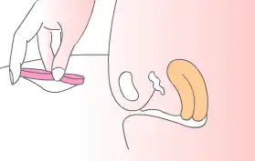 Inserting a thin-walled menstrual disc/ring-shaped cup. Pinching the sides of the cup together and positioning it for insertion.