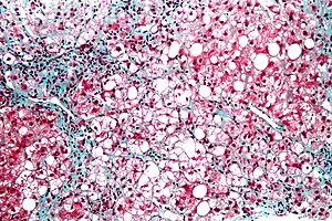 Micrograph of inflamed fatty liver (steatohepatitis)