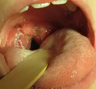 A set of large tonsils in the back of the throat, covered in white exudate. A culture positive case of streptococcal pharyngitis with typical tonsillar exudate in an 8-year-old.