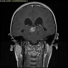 T1-weighted coronal MRI image postcontrast showing heterogeneous contrast enhancement within the presumed tectal plate glioma