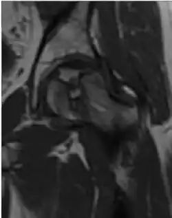 Coronal T1 of a patient with avascular necrosis of the femoral head.