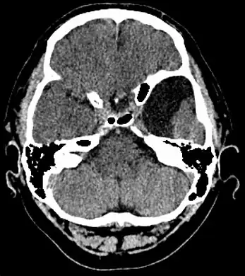 Axial CT showing a typical arachnoid cyst left temporal