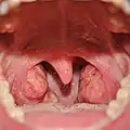 Anterior photograph of the oral cavity showing palatine tonsils (inflamed) and uvula