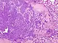 Micrograph of papillary thyroid carcinoma demonstrating prominent papillae with fibrovascular cores. H&E stain.