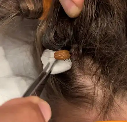 Engorged tick on the hairline.