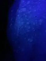 Wood's lamp: fluorescence of pityriasis versicolor