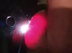 Epididymal cyst illuminated by a flashlight