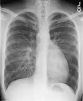 X-ray showing characteristic finding in case of transposition of the great vessels which is called egg on side sign