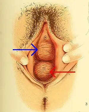 Drawing of both a cystocele (blue arrow) and rectocele (red arrow).