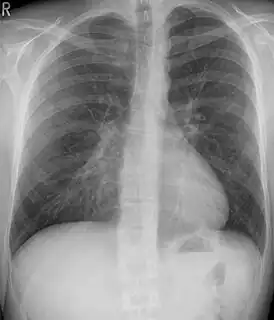Pectus excavatum on PA chest radiograph with shift of heart shadow to the left and radioopacity of the right paracardiac lung field