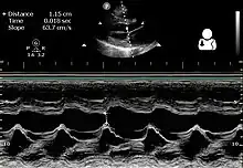 Ultrasound of peripartum cardiomyopathy[23]