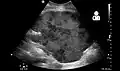 Postoperative bleeding following kidney transplant as seen on ultrasound