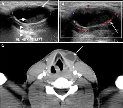 Fig. 19. Long-standing infected thyroglossal duct cyst in a 29-year-old male patient. a Transverse greyscale ultrasound at midline, just above the level of the thyroid gland, shows an oval cystic lesion with internal echoes (white arrows) and posterior enhancement (arrowheads). b Transverse colour Doppler ultrasound shows surrounding peripheral flow (white arrow). c Axial enhanced neck CT scan at the level of the thyroid cartilage demonstrates a slightly off-midline, well-defined, homogeneous cystic lesion embedded in the left strap muscle with peripheral enhancement (white arrow). It shows no calcification or internal enhancement. Thyroid gland was normal (not shown).