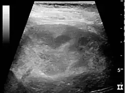 Kidney ultrasonograph of acute pyelonephritis with increased cortical echogenicity and blurred delineation of the upper pole.[16]