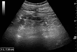 Chronic pyelonephritis with reduced kidney size and focal cortical thinning. Measurement of kidney length on the US image is illustrated by '+' and a dashed line.[44]