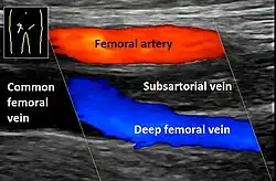 Doppler ultrasonography showing absence of flow and hyperechogenic content in a clotted femoral vein (labeled subsartorial[lower-alpha 10]) distal to the branching point of the deep femoral vein. When compared to this clot, clots that instead obstruct the common femoral vein cause more severe effects due to impacting a significantly larger portion of the leg.[85]