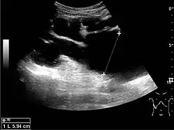 Figure 15. End-stage hydronephrosis with cortical thinning. Measurement of pelvic dilatation on the US image is illustrated by '+' and a dashed line.
