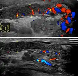 Doppler ultrasound of epididymitis, seen as a substantial increase in blood flow in the left epididymis (top image), while it is normal in the right (bottom image). The thickness of the epididymis (between yellow crosses) is only slightly increased (7&nbsp;mm).
