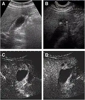 Non-contrast abdominal ultrasound and contrast-enhanced ultrasound (CEUS) of adenomyomatosis of the gallbladder:[8] a The fundus of the gallbladder wall was thickened and the GB wall was obscure. b The intramural echogenic foci were detected by high frequency transducer. c CEUS—arterial phase (22 s) —heterogeneous hyper-enhancement and wall was intact. d CEUS—venous phase (34 s) the anechoic spaces were more clear.