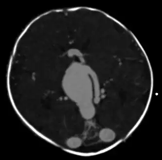 vein of Galen malformation