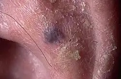 Venous lake of the ear