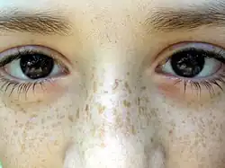 Freckles