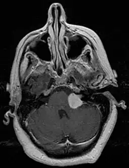 Unilateral vestibular schwannoma