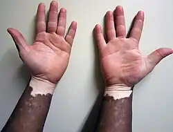 Non-segmental vitiligo on dark skin, hand facing up