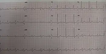 A short PR in Wolff–Parkinson–White syndrome