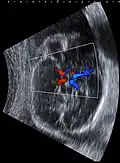 Fetal ultrasound image at the level of circle of Willis, showing PCA, MCA and ACA