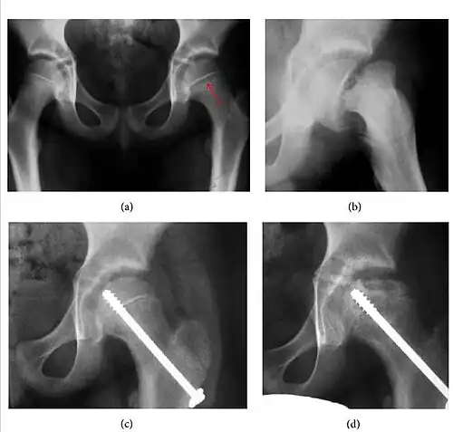 Figure 4: (a) X-ray of a 10-year-old child with left hip pain. It was considered normal at emergency despite the widening of the left physis (arrow). Two weeks later epiphysiolysis was evident (b). Despite appropriate surgical reduction (c) osteonecrosis developed and femoral head collapsed 1 month later (d).