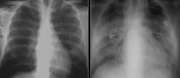 These chest radiographs are of two patients. Both show ground glass opacities. The left X-ray shows a much more subtle ground-glass appearance while the right X-ray shows a much more gross ground-glass appearance mimicking pulmonary edema.[22]
