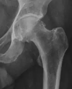 Radiograph of a pincer type impingement.