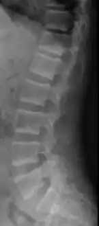 X-ray of a subtle "rugger jersey spine" due to sclerotic bands adjacent to the vertebral endplates.[17]