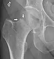 X-ray showing a suspected compressive subcapital fracture as a radiodense line