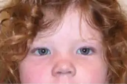 Epicanthal folds and increased distance between the eyes in 2-year-old girl with trisomy X[2]