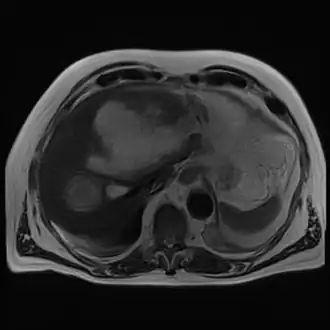 Magnetic resonance cholangiopancreatography (MRC) image showing a voluminous and heterogeneous collection in the left liver lobe (amoebic abscess)