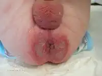 Severe diaper rash with ulceration[7]