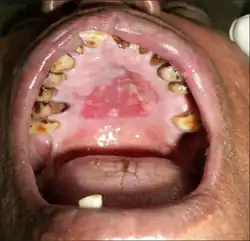 Fixed drug reaction on hard palate