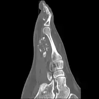 Florid reactive periostitis[5]